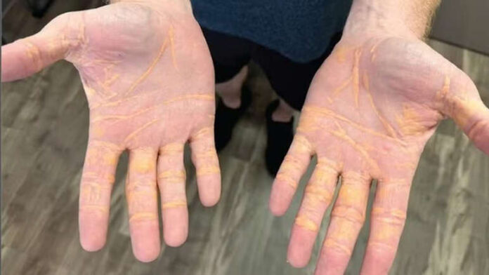 Homem desenvolve nódulos de colesterol nas mãos após dieta rica em gordura