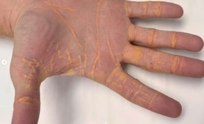 Homem desenvolve nódulos de colesterol nas mãos após dieta rica em gordura 1 Homem desenvolve nódulos de colesterol nas mãos após dieta rica em gordura - Foto das mãos