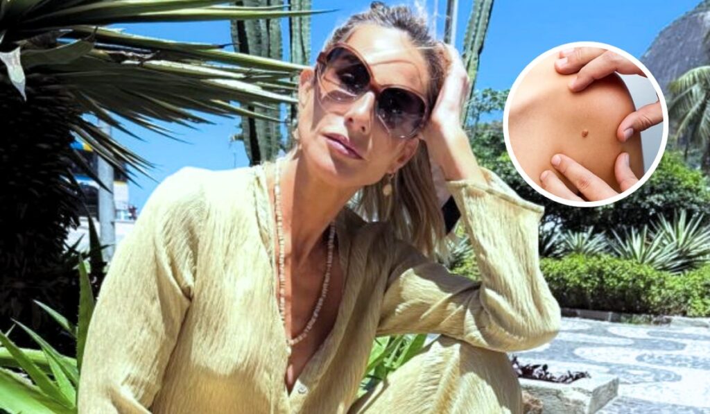 Carcinoma Basocelular: O que é e Como Prevenir Após Caso de Mariana Weickert 1 padrao fotos blumenau 99